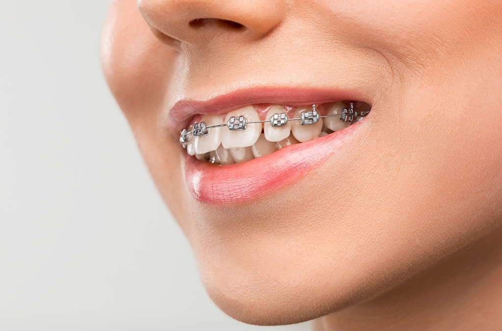 bracestraditional