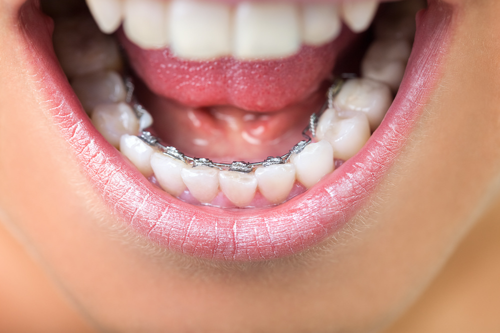 lingualbraces